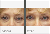 Eyelid Surgery Before and After Photos
